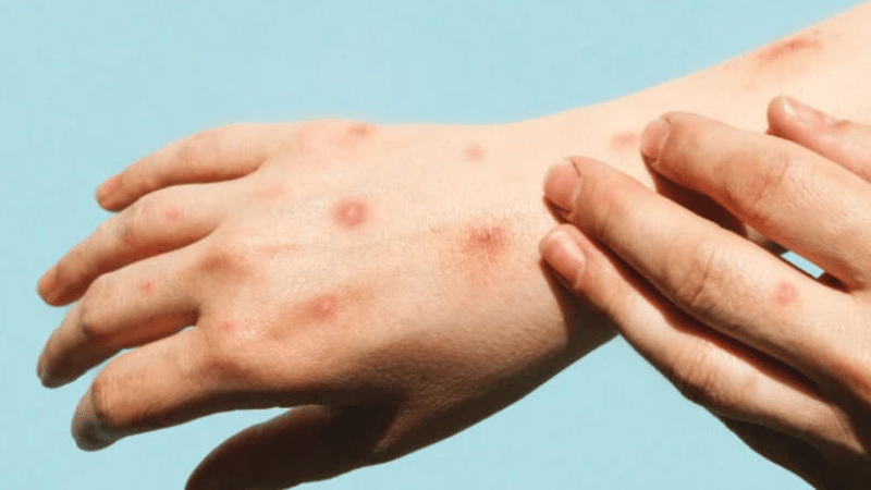 La OMS mantiene la emergencia sanitaria internacional por el rebrote de mpox